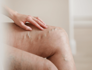 Prevenção de varizes: dicas do Dr. Rômulo Mendes, angiologista em Goiânia